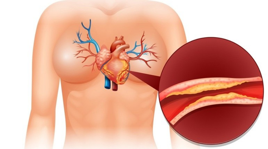 Novo método poderá mostrar com precisão quem está prestes a ter um infarto ou AVC 1